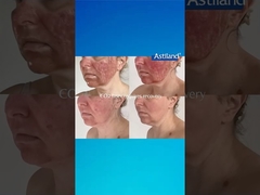 HIFU vs. CO2-Laser, welches bevorzugen Sie?