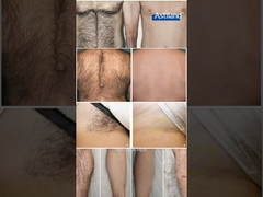 Laser-Haarentfernung vor und nach