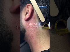 Dioden-Laser gegen ND-YAG-Laser, welchen bevorzugen Sie?