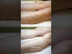 Wir präsentieren Ihnen die neueste Fiber Laser Haarentfernung Maschine, Astiland Fibermax!