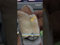 Lass uns die Sofort-Lifting-Wirkung von HIFU überprüfen